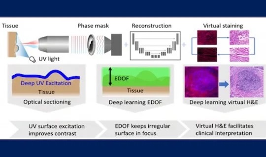 Imagen:  El sistema de patología puede acelerar la evaluación precisa de los márgenes tumorales en el cáncer de mama y de cabeza y cuello (Foto cortesía de Richards-Kortum Optical Spectroscopy and Imaging Laboratory/Rice University)